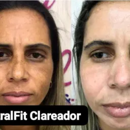 ❤️ MELASMA & produtos ❤️