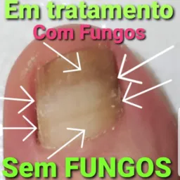 Fungos/Micoses 💅❤👣